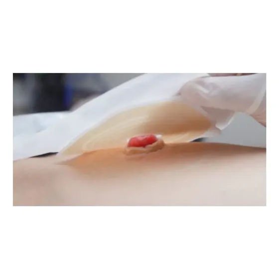 Bolsa Colostomia Ostomia Transparente 10 Und. C/ Reg. Anvisa