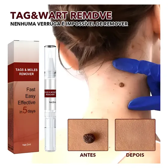 Para Removedor De Moles Matar Caneta Líquida Anti-verrugas